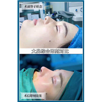 重庆肋软骨隆鼻手术