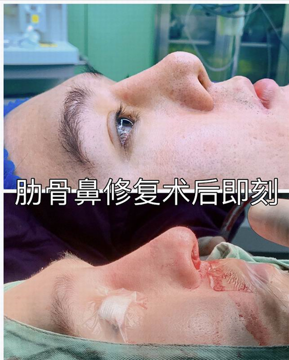 重庆鼻整形修复