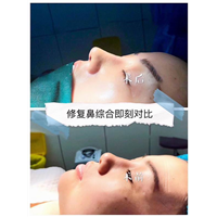 重庆鼻整形修复