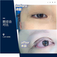 重庆双眼皮修复 