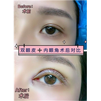 重庆双眼皮修复 