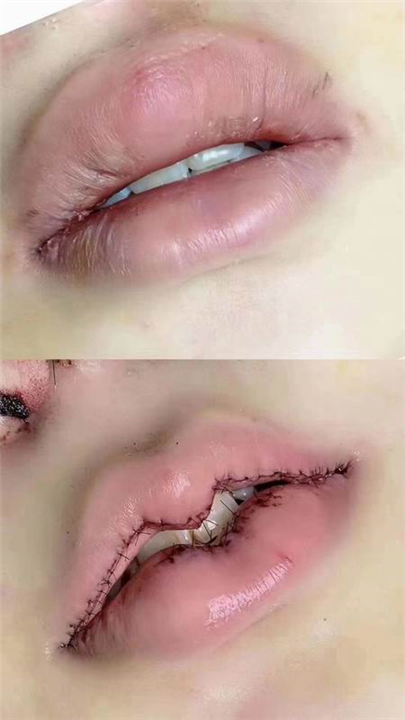 天丽卡婕宁整形 