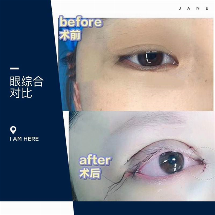 重庆双眼皮修复 