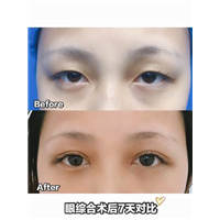 重庆双眼皮修复 