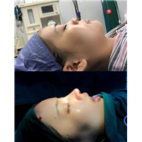 重庆肋软骨隆鼻手术