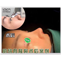 重庆鼻整形修复