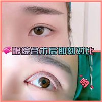 重庆双眼皮修复 