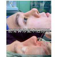 重庆鼻整形修复