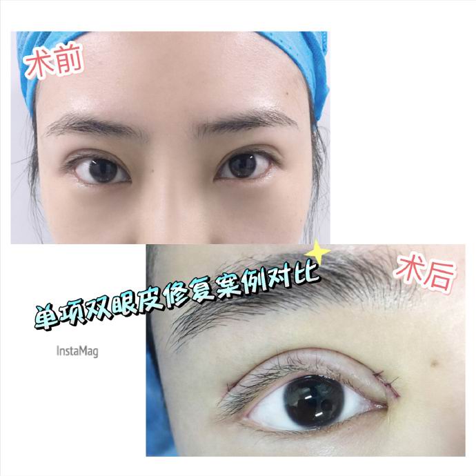 重庆双眼皮修复 