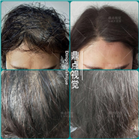 女士头顶稀疏加密