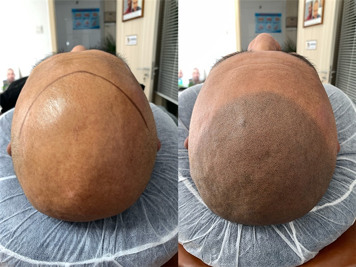 男士发际线调整