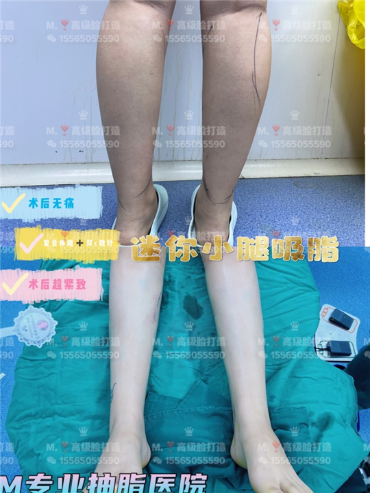 郑州0血水吸脂