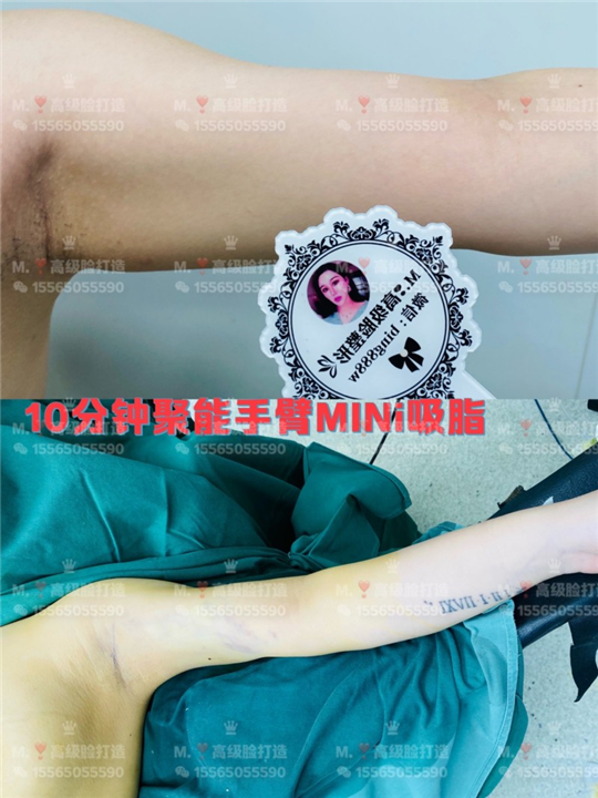 0血水无痛手臂抽脂