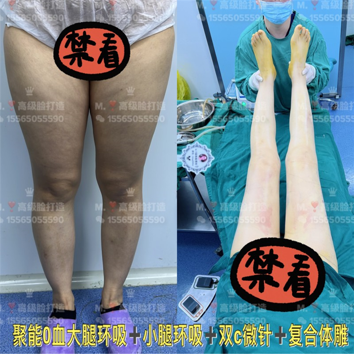 0血水吸脂哪家好