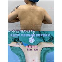 郑州0血水无痛抽脂