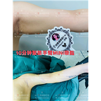0血水无痛手臂抽脂