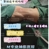 郑州腰腹环吸0血水抽脂