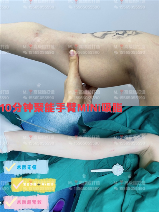 0血水手臂吸脂