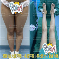 郑州零血水吸脂