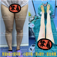 0血水吸脂哪家好