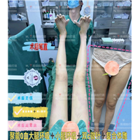 腰腹环吸0血水抽脂