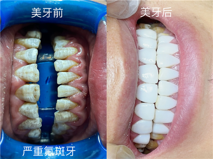 武汉做纳米美牙哪家好
