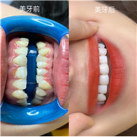武汉做牙齿美白哪家好