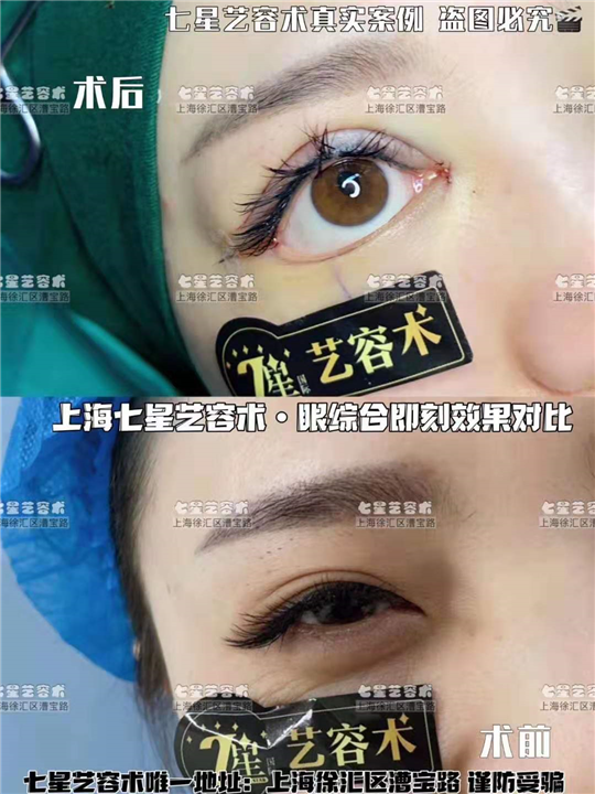 上海眼综合四项整形 