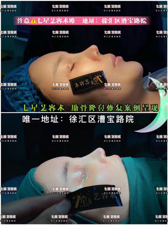 上海七星艺容术肋骨隆鼻 