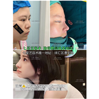 上海肋软骨鼻综合整形 