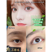 上海七星艺容术修复双眼皮 
