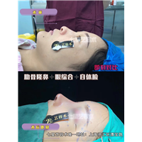 上海肋软骨鼻整形多少钱 