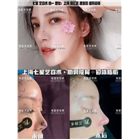 上海肋骨隆鼻➕自体脂肪复合设计 