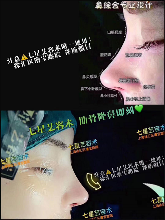 上海肋骨鼻综合 