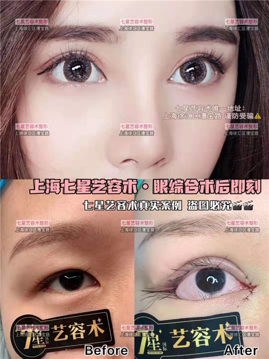 上海眼综合整形 