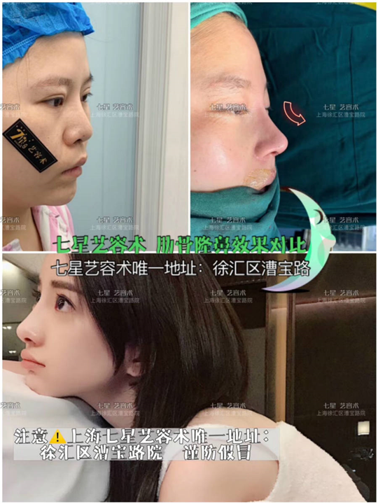 上海肋软骨鼻综合整形 