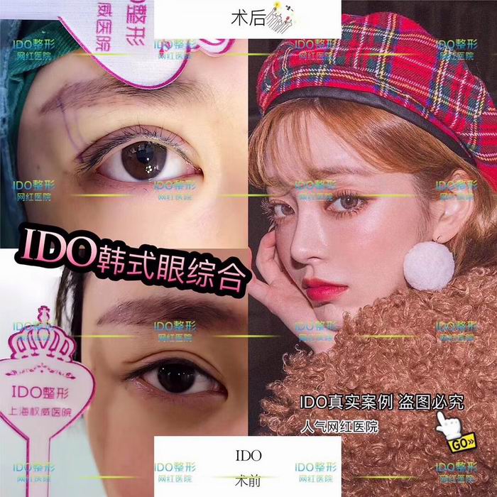 上海眼综合@上海眼综合整形 