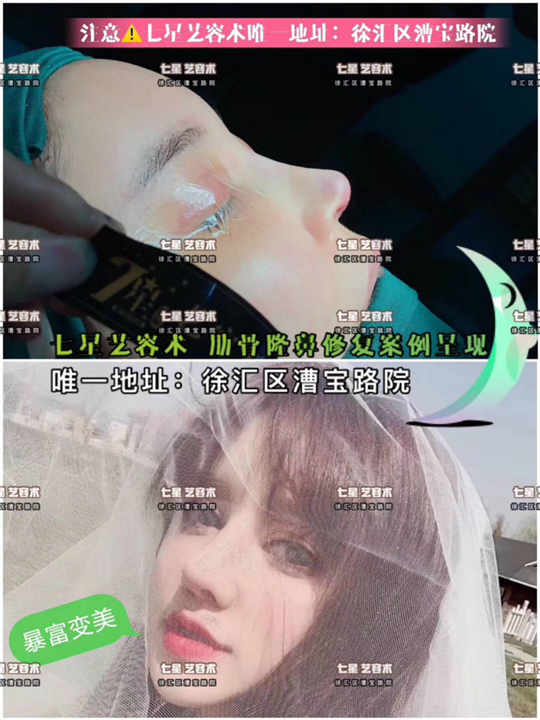 上海肋骨鼻修复整形 