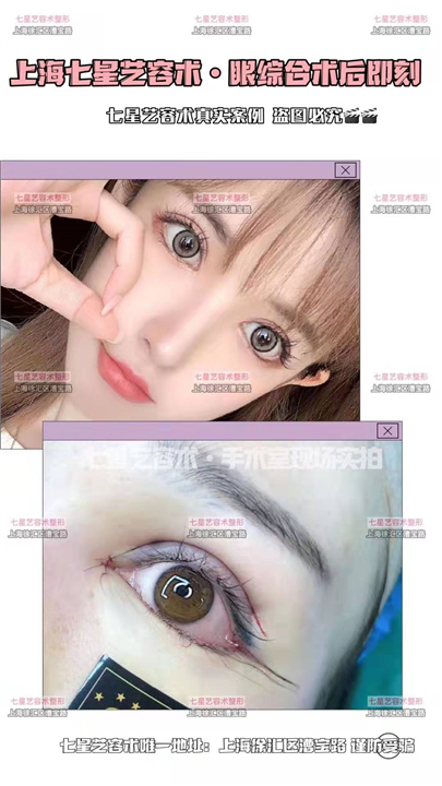 上海七星艺容术眼综合整形 