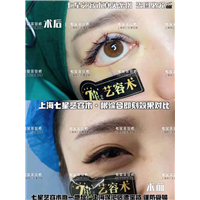 上海眼综合四项整形 