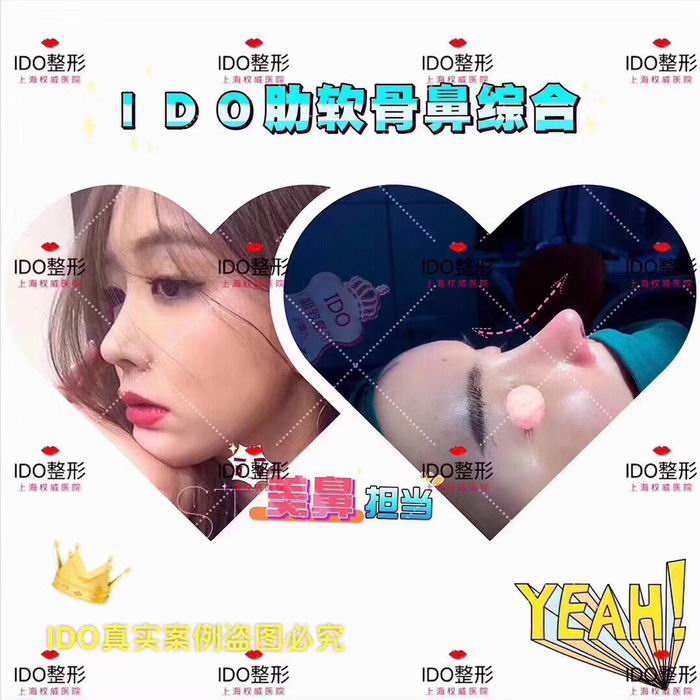 上海鼻综合手术@上海专业鼻综合整形医院 