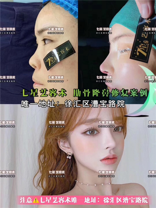 上海肋骨隆鼻修复 