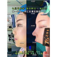 上海七星艺容术肋骨鼻修复整形 