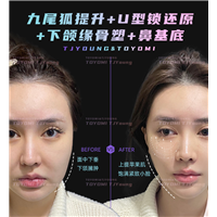 罗子璇--九尾狐 U型锁 下颌缘 鼻基底 (3)