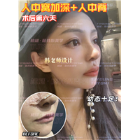 李玲玲-人中窝人中脊2