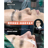 王晶-肋骨鼻+鼻基底 (2)