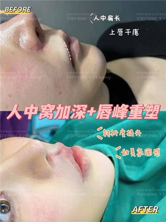 甘丽 人中窝 唇峰 (2)