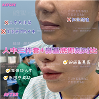 1马运超-赫本带鼻基底双眼皮眼底筋膜人中三件套