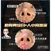 张翠红肋骨鼻2