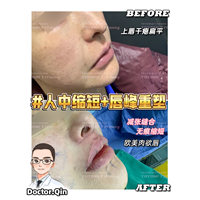 王娟-人中缩短+唇峰重塑 (2)